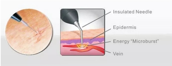 Σελόν ομορφιάς 980nm Diode Laser Machine για ανακούφιση πόνου / αγγειακή θεραπεία