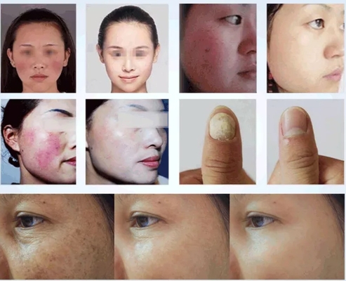 Σελόν ομορφιάς 980nm Diode Laser Machine για ανακούφιση πόνου / αγγειακή θεραπεία