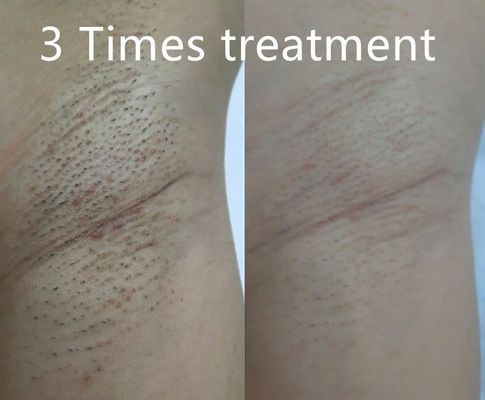 Συσκευή αποτρίχωσης με δίοδο λέιζερ πολλαπλών λειτουργιών που υποστηρίζει διαφορετικά πλάτη παλμού για εξατομικευμένη μόνιμη μείωση της τριχοφυΐας