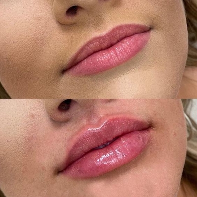 50% έκπτωση Ice Platinum depiladora Laser αφαιρέτης μαλλιών μήκος κύματος 755nm 808nm 1064nm