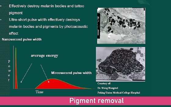 Μηχανή απομάκρυνσης τατουάζ με laser μίας δευτερόλεπτης σε σταθερό στυλ
