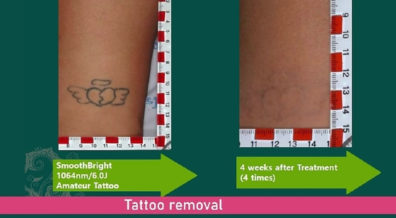 1064nm Q Switched Nd Yag Laser Picosecond Μηχανή Απομάκρυνσης Τατουάζ Σταθερό στυλ