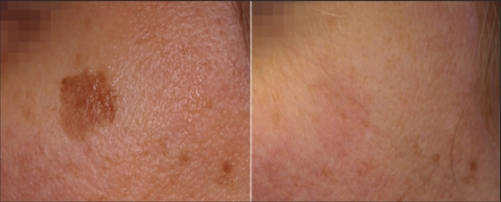 Προσαρμοσμένο Q Switch ND Yag Laser Machine για την αφαίρεση τατουάζ / θεραπεία ακμής