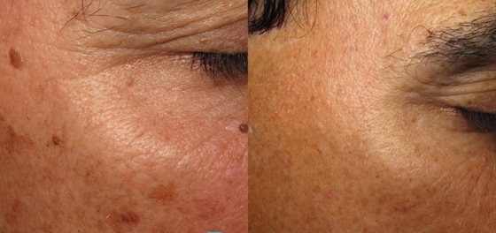 Προσαρμοσμένο Q Switch ND Yag Laser Machine για την αφαίρεση τατουάζ / θεραπεία ακμής