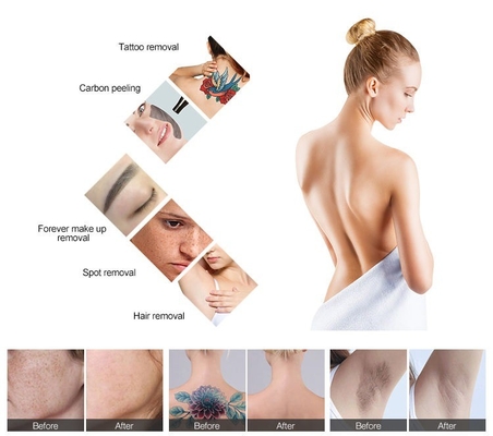 Μηχανή αποτρίχωσης λέιζερ 2 σε 1 Διοδίου laser Nd YAG Laser