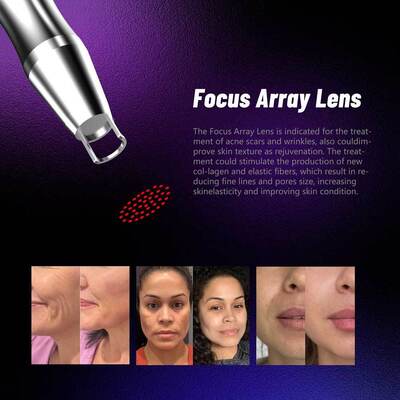 3000W 350PS Picosecond Pico Way Laser Απομάκρυνση χρωστικής ουσίας Nd Yag Laser Picosecond Tatoo Removal Laser Machine EU Plug